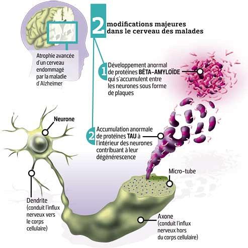 Alzheimer un grand défi pour la médecine